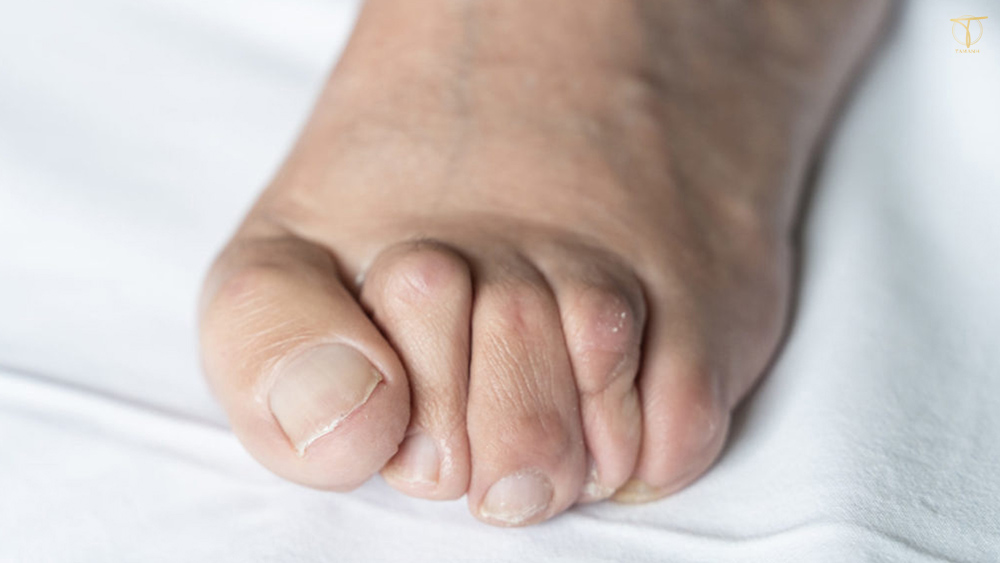 tác hại của giày bị chật khiến ngón cái bị vẹo